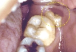 智慧齒長出時附近的牙肉紅腫發炎，形成智慧齒冠周炎