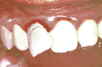 牙齿碰撞后出现牙齿移位