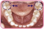 The six-year molar erupt right behind the last primary molar in each quadrant.