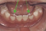 The lower permanent incisors erupt behind the primary incisors.