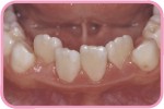 下頜的恆門牙長出時不夠空位，引致牙齒排列參差不齊