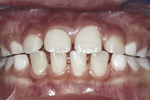 由于恆齿的体积跟颌骨不配合，恆门牙排列出现空隙