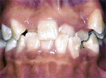 Teeth are mal-aligned before orthodontic treatment.