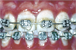 Teeth are undergoing orthodontic treatment.