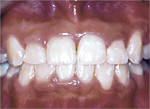 Teeth are mal-aligned before orthodontic treatment.