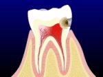 A cross-section diagram showing the dental caries extends into the pulp of a tooth.