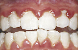 Dental plaque accumulates at gingival margin causing gingivitis.