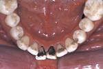 Brown and black stains on the surface of teeth