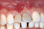 A tooth appears greyish-black in colour because of non-vital pulp.