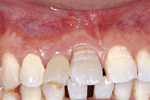 The tooth colour was whitened after appropriate dental treatment.