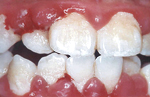 Dental plaque accumulating at gum margin leads to gingival inflammation with swelling and bleeding.