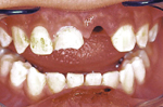 An upper incisor was avulsed due to trauma
