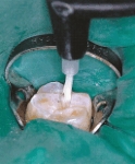 Fissure sealant is applied on the chewing surface of a molar.