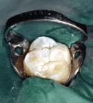 A molar with narrow and deep fissure.