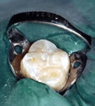 Fissure sealant seals off the fissure to prevent plaque accumulation.