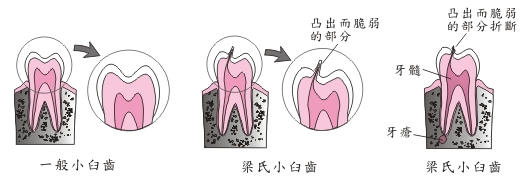 梁氏小臼齒在咬合面上有一個凸出而脆弱的部分，折斷後可能會導致牙髓發炎壞死，形成牙瘡