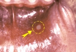 An aphthous ulcer is found on the oral mucosa.