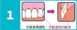 牙菌膜积聚在牙肉边缘的位置