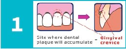 Dental plaque accumulated at the gingival crevice.
