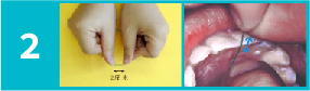 用雙手的姆指和食指控制一段兩厘米長的牙線並前後拉動將牙線滑入牙縫內