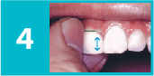 Wrap the floss around the other tooth and slide it up and down.