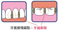牙菌膜會積聚在牙齒鄰面