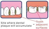 Dental plaque accumulates on tooth adjacent surfaces.